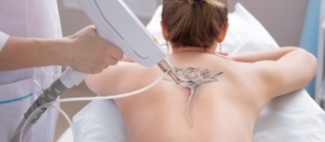conseils detatouage laser toulouse beauzelle