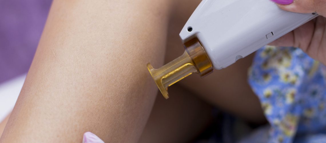 épilation laser poils