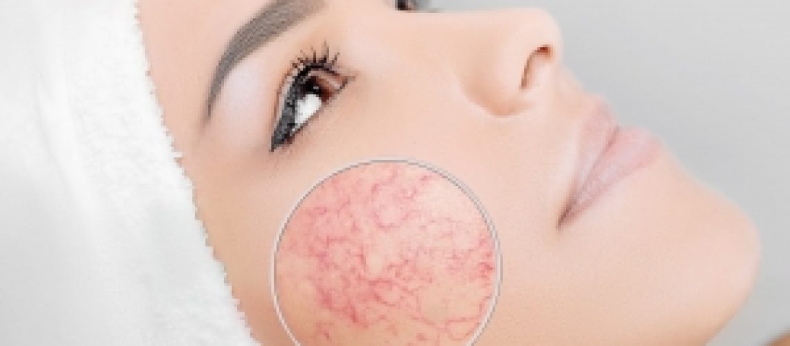 lasers-lesions-vasculaires-beauzelle-toulouse